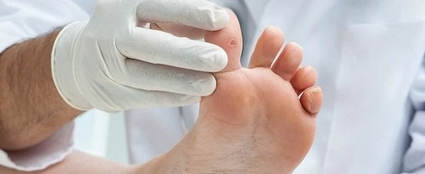 Κονδυλώματα: Ένας οδηγός πρόληψης και αντιμετώπισης